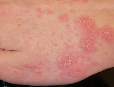 Ψώρα: Πώς θα καταλάβετε ότι έχετε πρόβλημα – Ποια θεραπεία υπάρχει